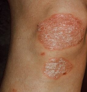 Psorisasis - Medical Skin Associates